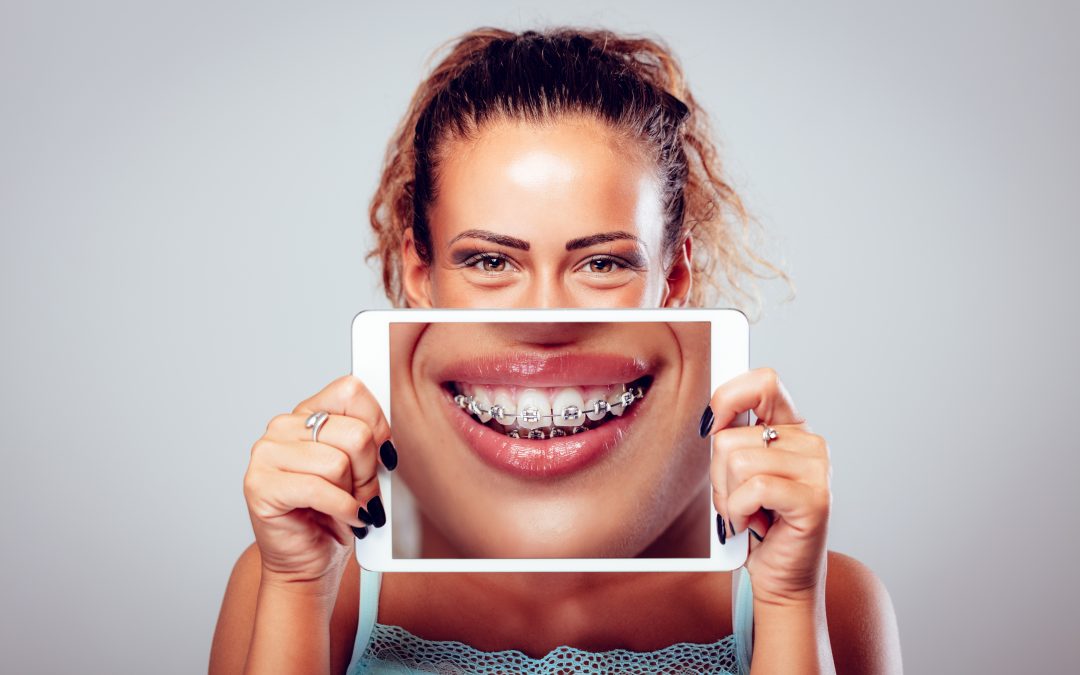 How Do Braces Work for Adults?