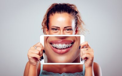 How Do Braces Work for Adults?