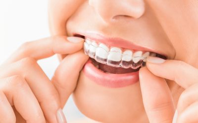 Invisalign Braces in Birmingham: A Guide for Patients Who Want a Beautiful Smile