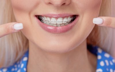 How to Take Care of Your Ceramic Braces