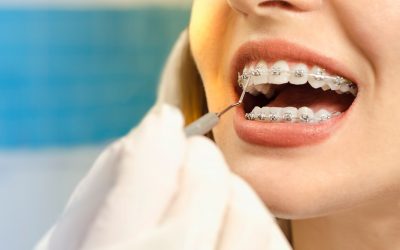 Brace Yourself Solihull: A Guide to Adult Braces Options