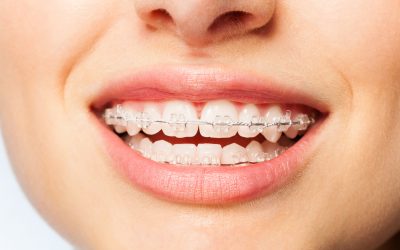 Finding the Perfect Fit with Clear Ceramic Braces