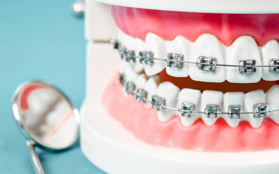 Are Train Tracks Braces Right for You? A Comprehensive Guide