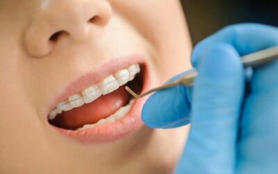 Can You Get Ceramic Braces on the NHS? A Clear Answer for UK Patients