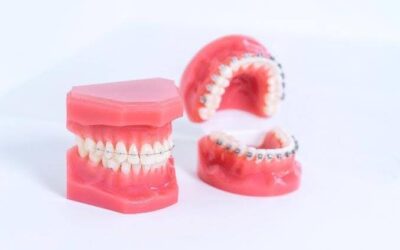 Are Ceramic Braces Available on the NHS? Everything You Need to Know
